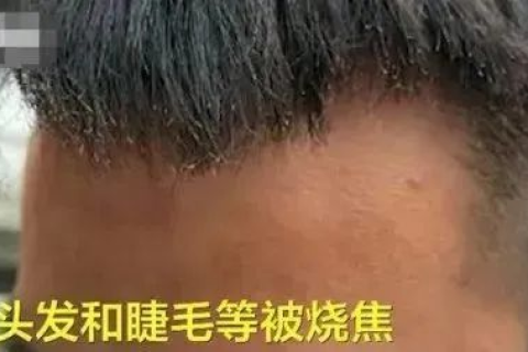梦见头发着火了，梦境解析与寓意探讨