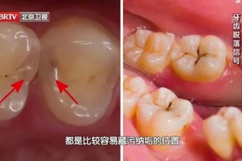做梦梦到蛀牙掉牙，梦境背后的深层含义与心理解析