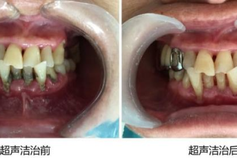 梦境解析，梦见牙齿掉了好多有血