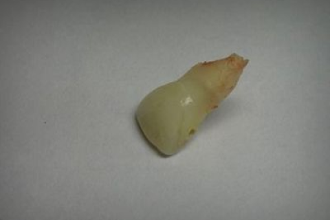 我梦见自己牙掉了掉了4颗，解析梦境背后的深层含义与心理启示