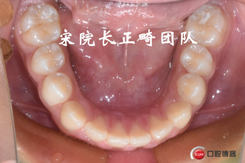 梦见自己掰掉一颗坏牙齿，探索梦境背后的深层含义与心理解析