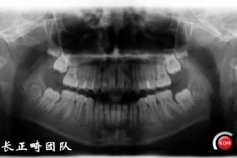 白天梦到掉牙，揭示梦境背后的深层含义与心理解析