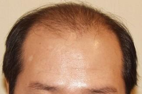 梦见自己头顶中间秃了一块，探索梦境背后的深层含义