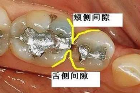 梦见下排牙齿掉落，探索梦境背后的深层含义