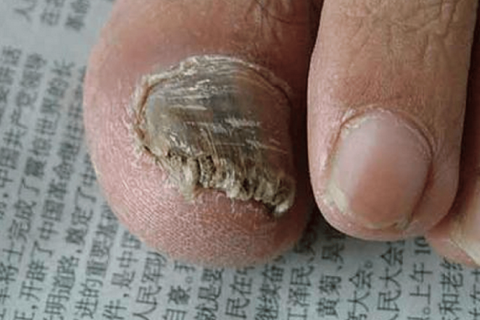 梦境解析，梦到大拇指甲脱落，无痛无血