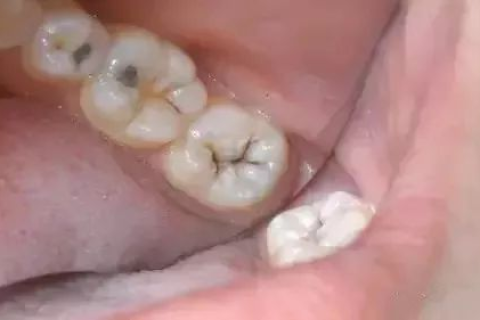 梦见掉大门牙，梦境背后的深层含义与解析