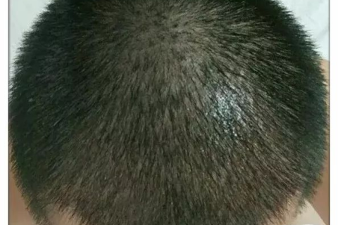 梦见自己脱发的很厉害，是凶是吉，还是什么的深层解析